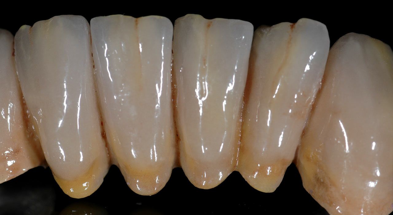 VMK - Metallkeramik