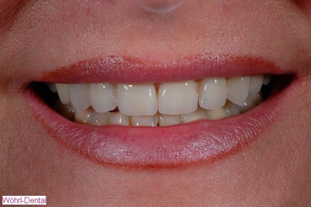 Wöhrl Dental Veneers