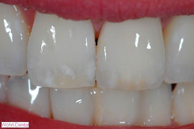 Wöhrl Dental Vollkeramik