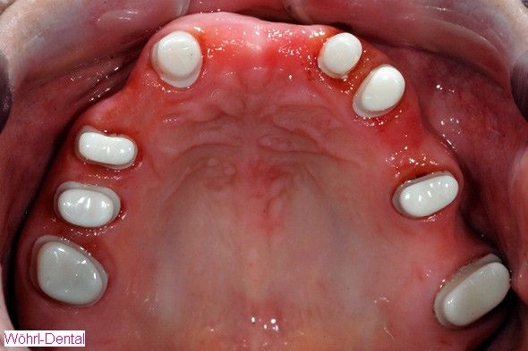 Wöhrl Dental herausnehmabre Brücken