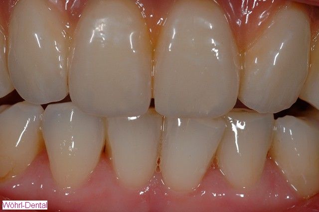 Wöhrl Dental herausnehmabre Brücken