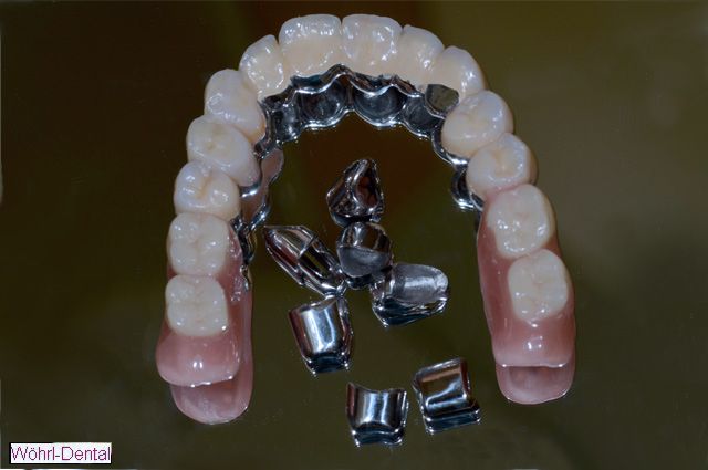 Wöhrl Dental Einstückgussverfahren