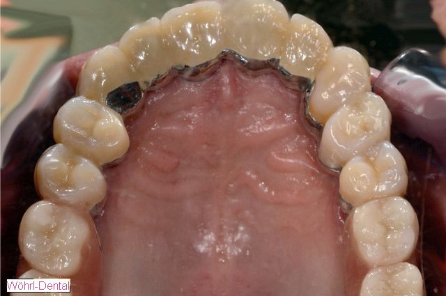 Wöhrl Dental Einstückgussverfahren