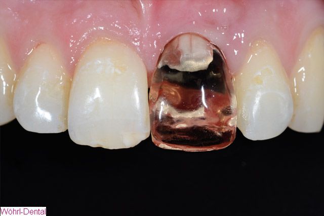 Wöhrl Dental Implantate CAD CAM