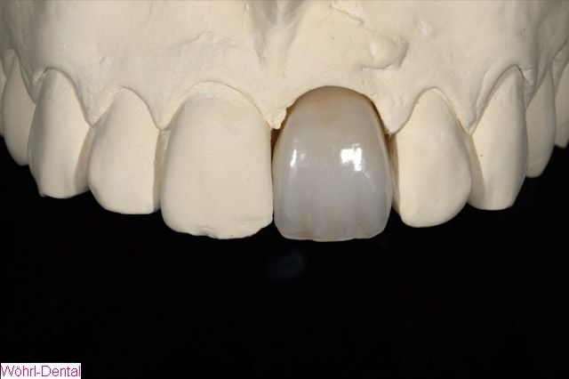 Wöhrl Dental Implantate CAD CAM