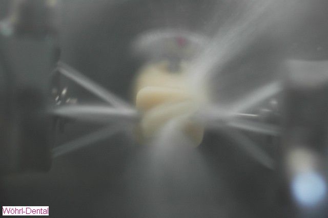 Wöhrl Dental Inlays