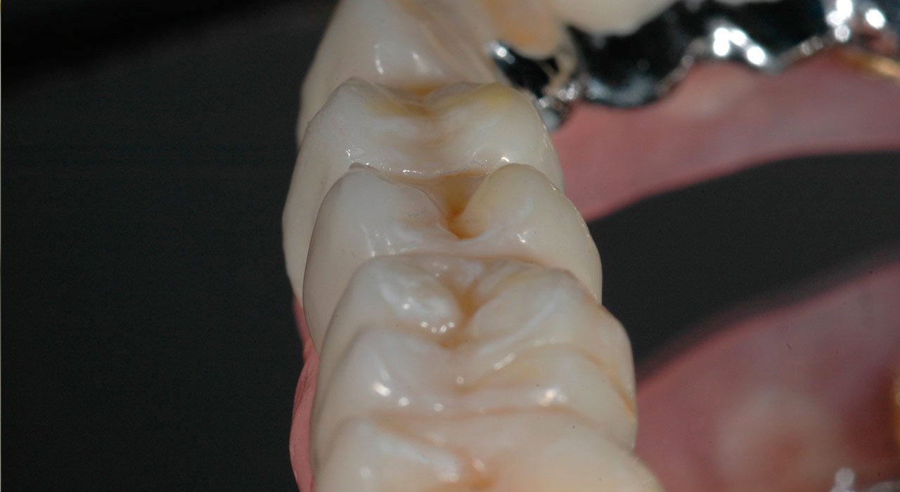 Herausnehmbare Brücken