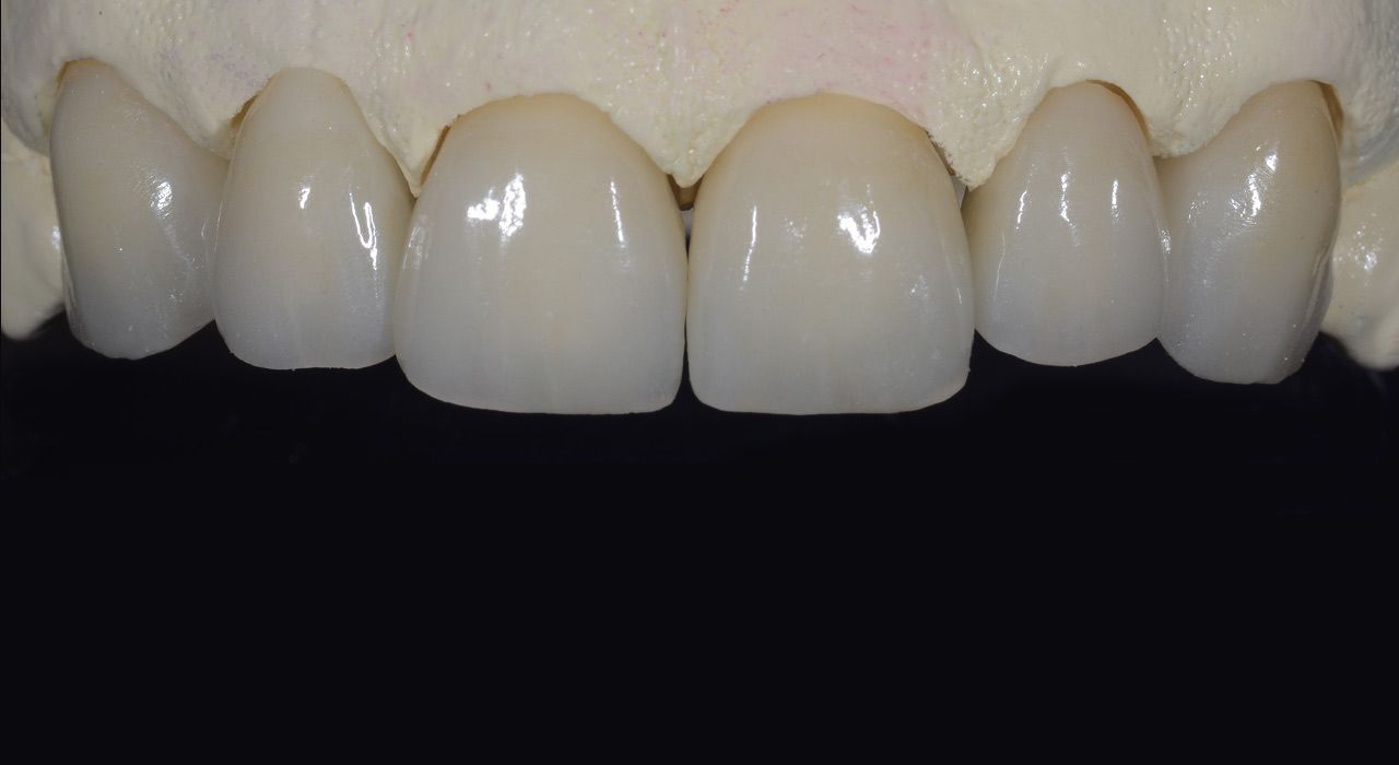 Vollkeramik - Presskeramik