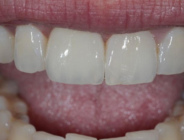 Individuelle Farbanpassung am Patienten