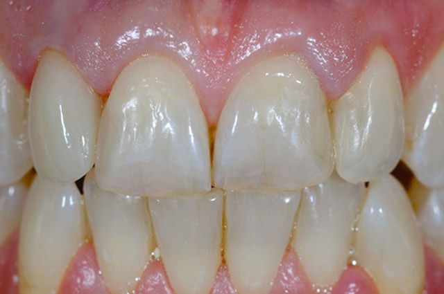 Wöhrl Dental Vollkeramik